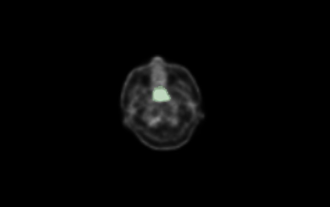 PET/CT 熱點辨識與定位