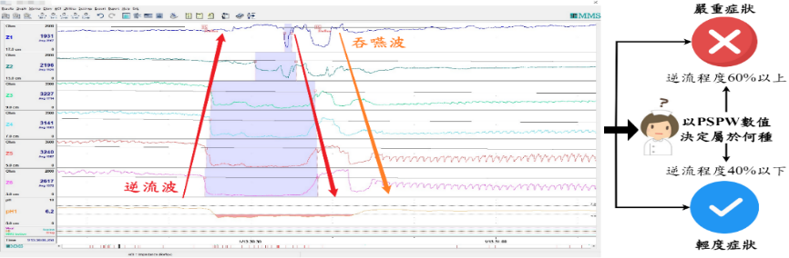 逆流後吞嚥（PSPW）辨識