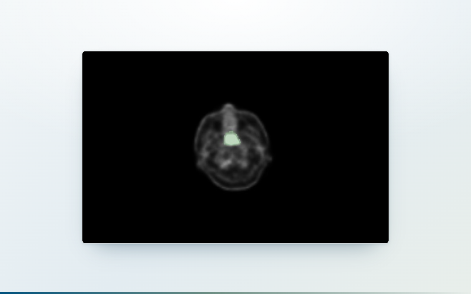 PET/CT Hotspot Detection & Localization