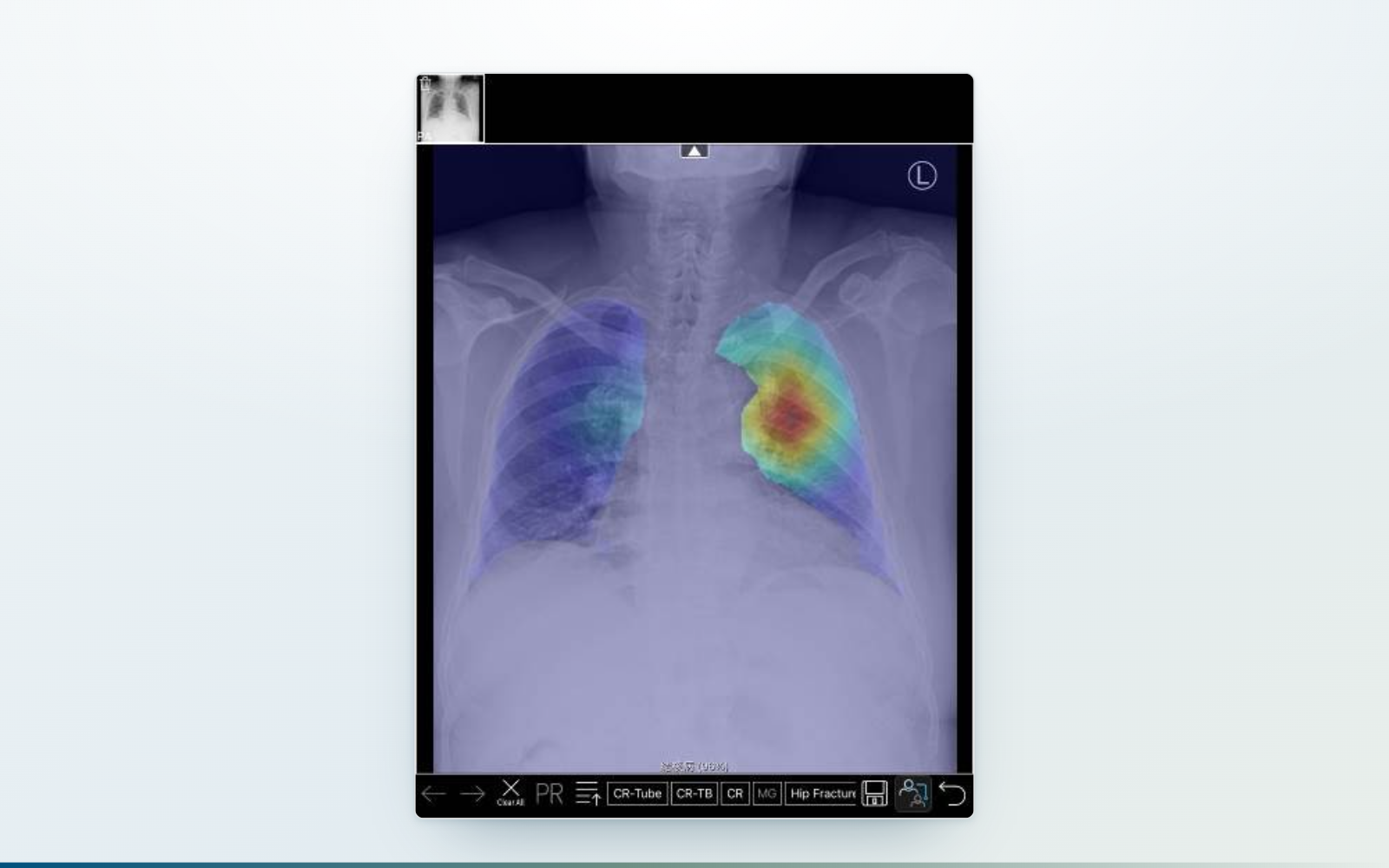Chest X-ray Interpretation Risk